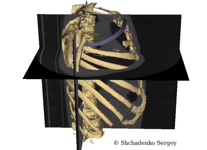 Образование и наука, Томские новости, Созданные томскими учеными 3D-модели органов и опухолей помогли врачам провести операции Созданные томскими учеными 3D-модели органов и опухолей помогли врачам провести операции