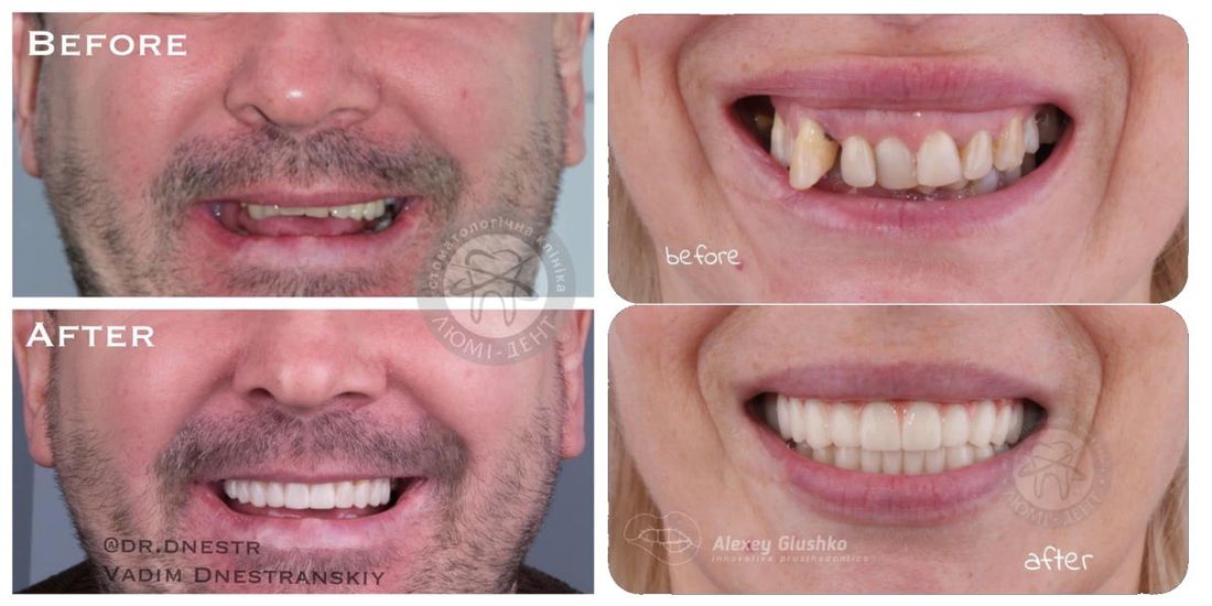 Томские новости, синус лифтинг Имплантационная стоматология: синус лифтинг