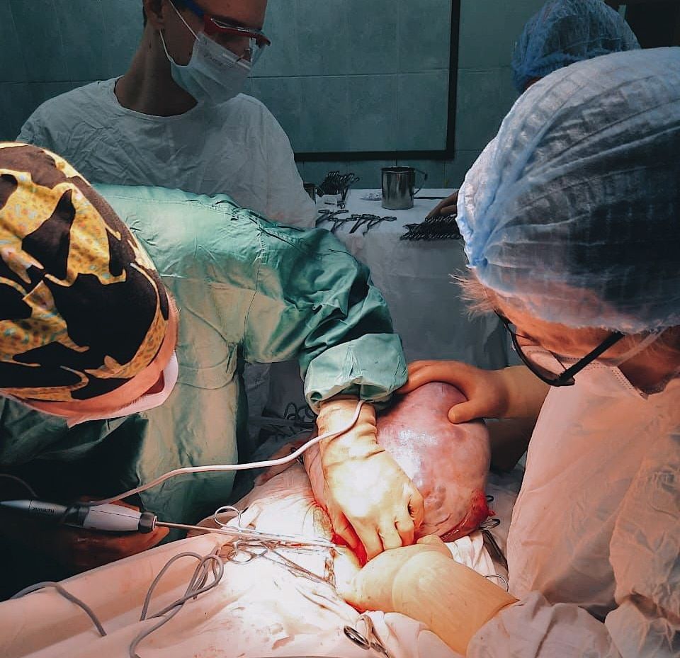 Медицина и здоровье, Томские новости, опухоль лечение медицина здоровье интересные новости Томска здравоохранение онкология лечение рака В Томске хирурги удалили у пенсионерки полуметровую опухоль