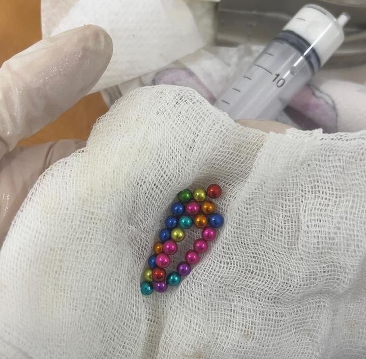 Город, Медицина и здоровье, Происшествия, Томские новости, дети проглотили магнит эндоскопические операции для ребенка интересные новости Томска жесть Более 30 магнитов достали врачи из желудка ребенка в Томской области