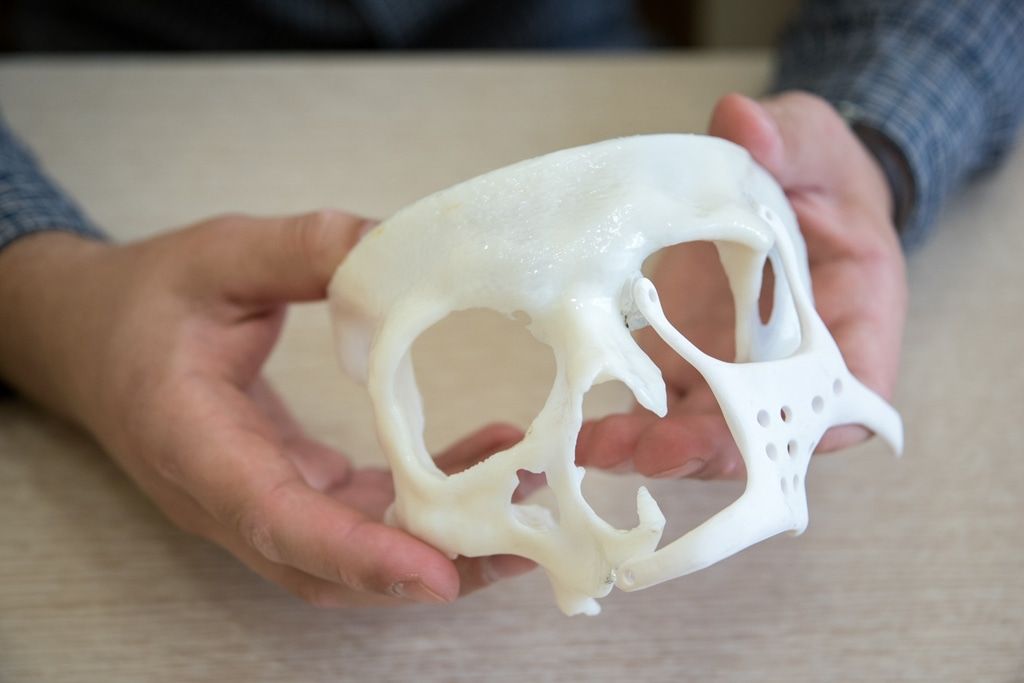 Медицина и здоровье, Образование и наука, Томские новости, нанокерамика дефект лица хирурги уникальная операция онкология остеогенная саркома В Томске сделали первую в России операцию по закрытию дефекта черепа нанокерамикой