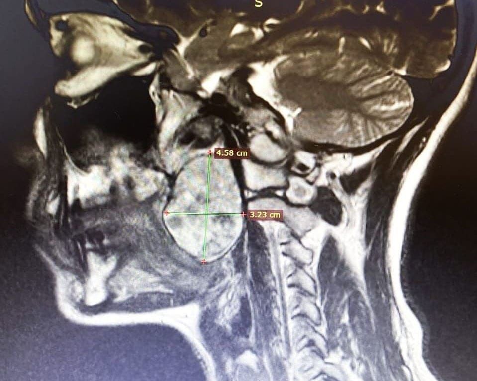 Здравоохранение в Томске и области, Медицина и здоровье, Томские новости, опухоль доброкачественное новообразование онкология лечение Томские врачи удалили опухоль глотки размером с куриное яйцо