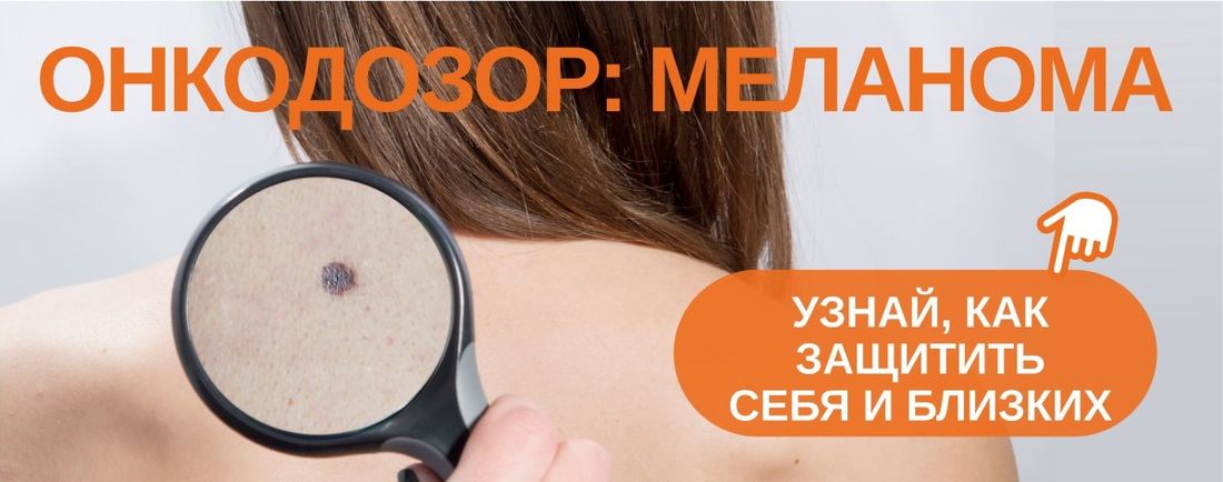 Медицина и здоровье, Томские новости, меланома рак опухоль воспаление родинка проверить В Томске создали «Онкодозор»
