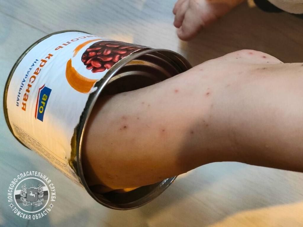 Происшествия, Томские новости, застрял курьезы интересные новости Томска сводка происшествий жесть В Томске нога трехлетнего мальчика застряла в жестяной банке