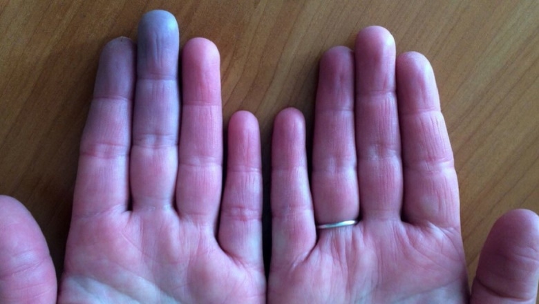Томский Обзор, новости, Мировые новости коронавирус фиолетовые пальцы ложное обморожение последствия коронавируса Врач из Новосибирска рассказала о фиолетовых пальцах после COVID-19